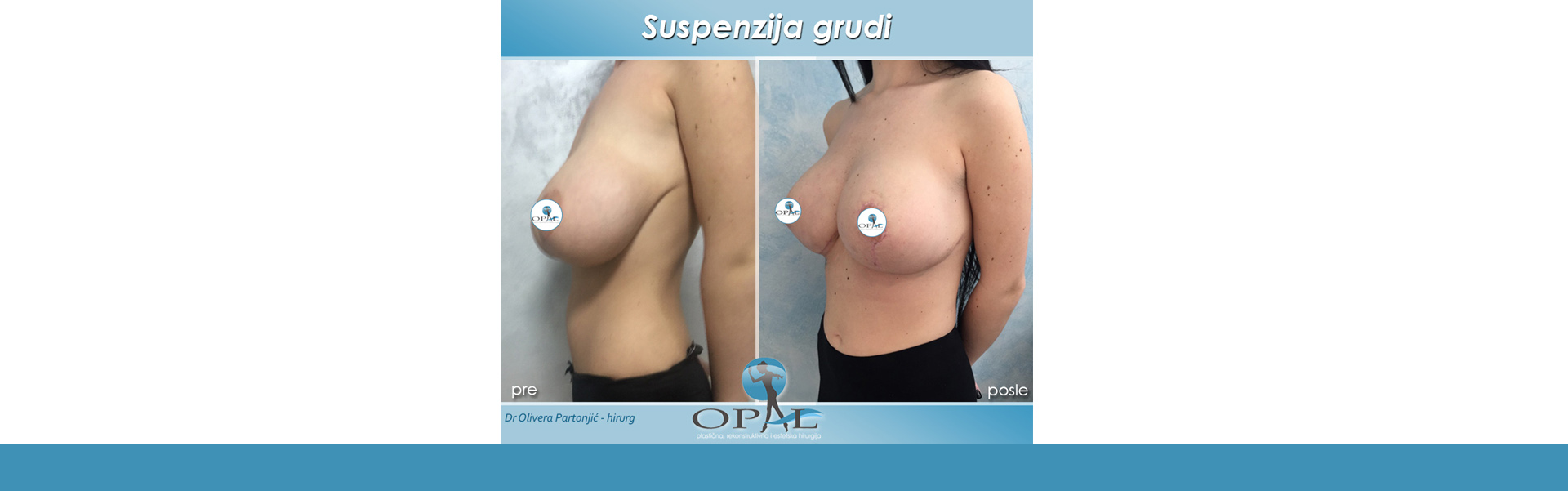 boram won like breast suspension videos photo brock robinson recommends breast suspension videos pic