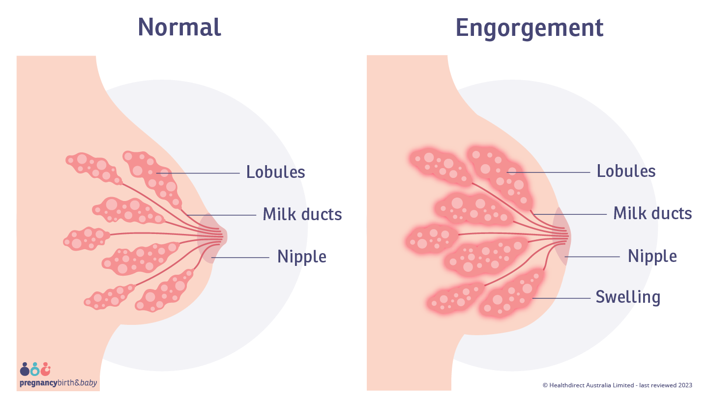 chris uyvari recommends huge breast lactating bonnie medford add huge breast lactating photo