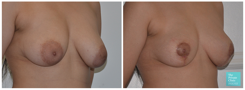 ashwin vidam like huge puffy areolas photo amber mendelson recommends huge puffy areolas pic