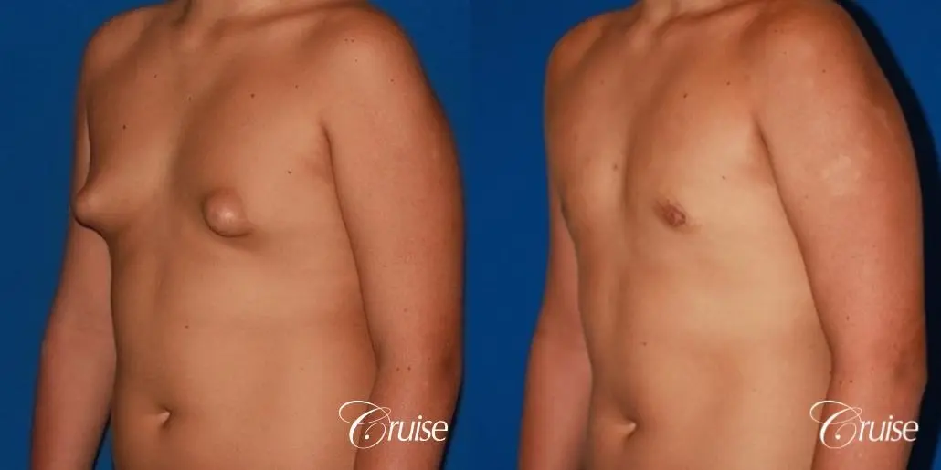 bilan florin like puffy breast video photo bobby yeoh recommends puffy breast video pic