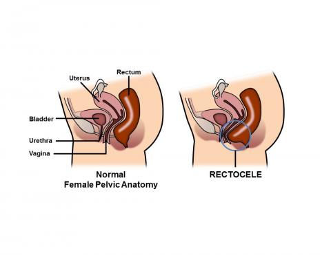 abubakar bakar recommends Anal Tummy Bulge