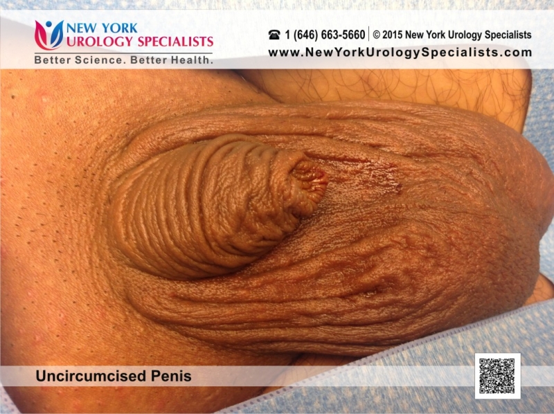 christopher ramlal recommends uncircumsized penis sex deborah stern add uncircumsized penis sex photo