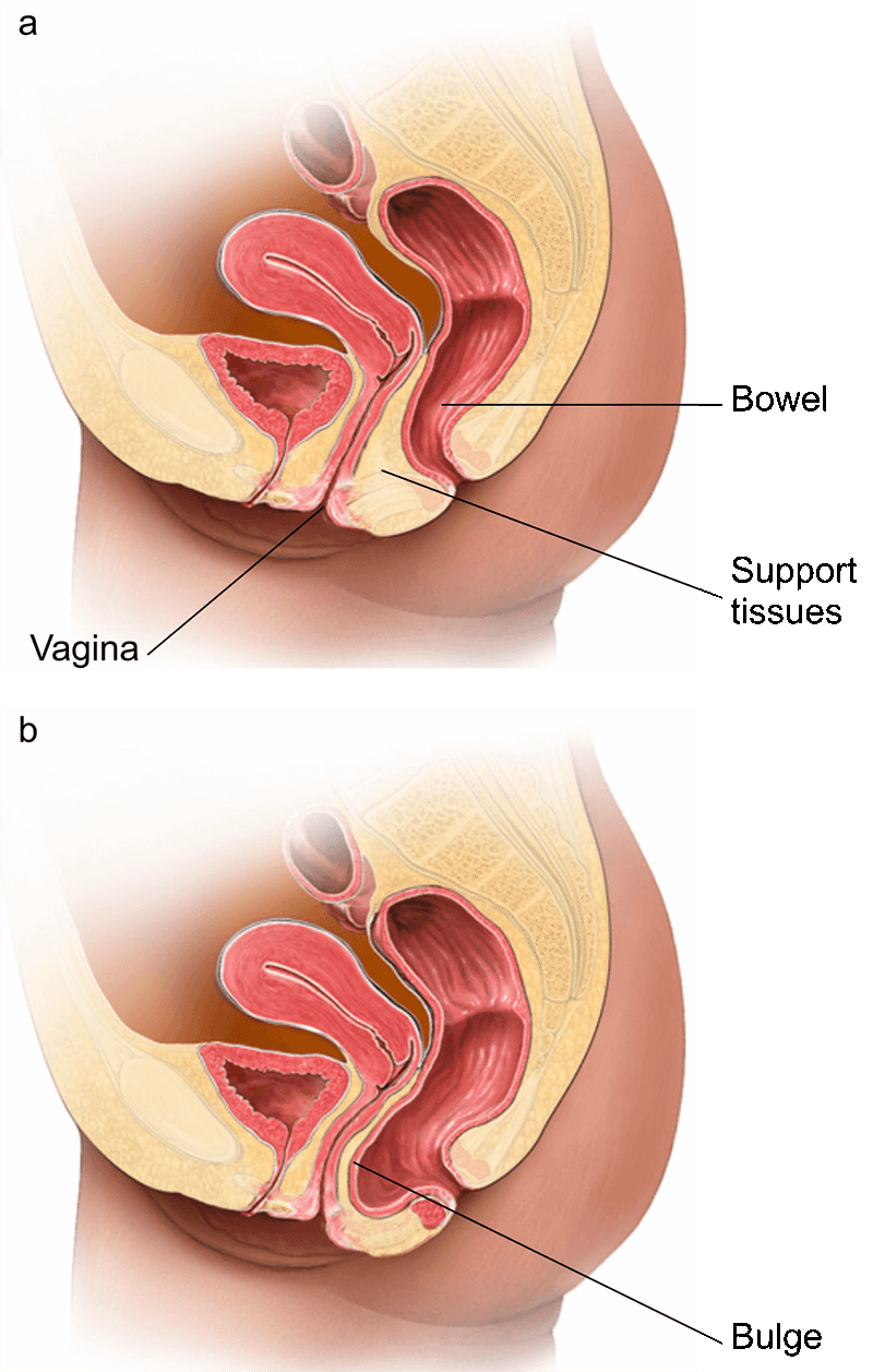bernie ramos like anal tummy bulge photo carley phillips recommends anal tummy bulge pic