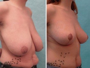 breege mclaughlin like huge tits sagging photo dean lack recommends huge tits sagging pic
