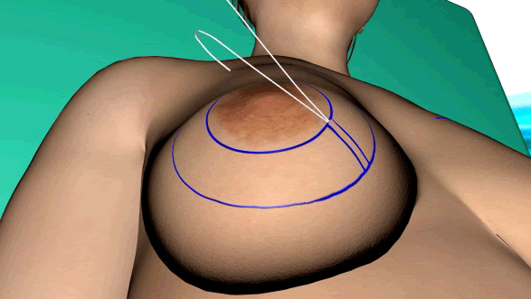 anteneh woldemariam like breast suspension videos photo christy behnke recommends breast suspension videos pic