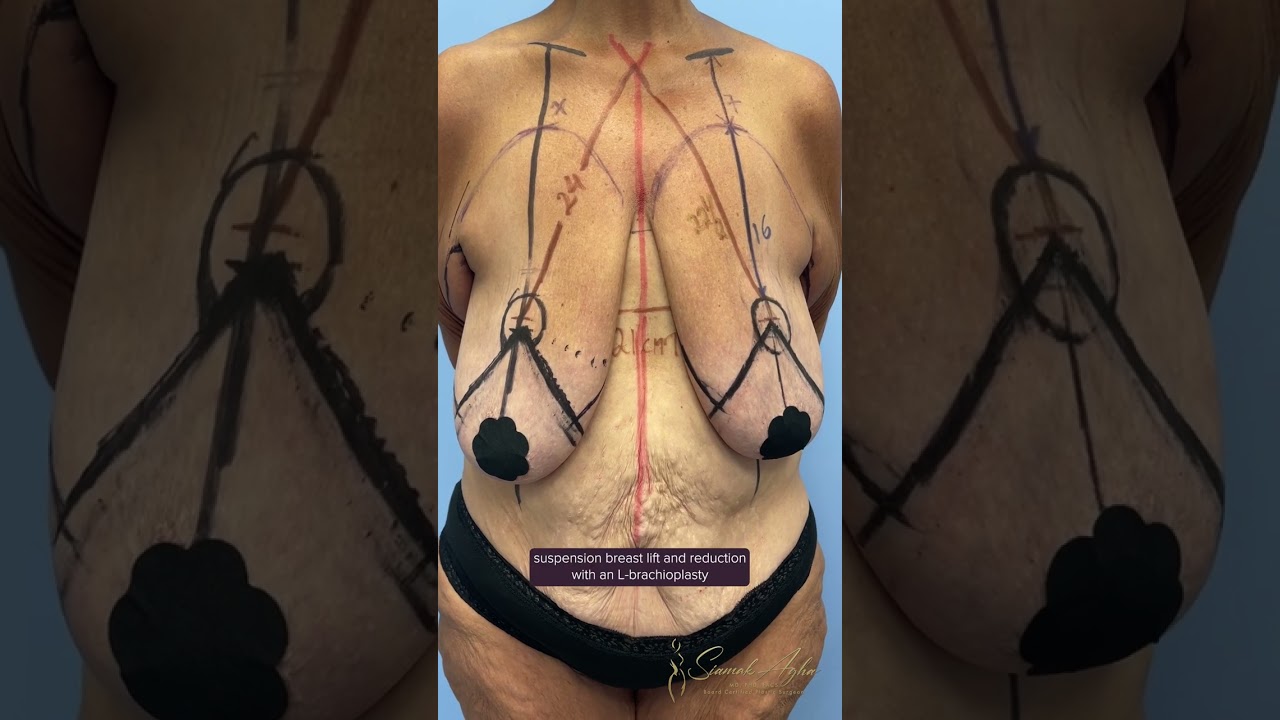 Breast Suspension Videos cordoba videos dawn medd recommends Breast Suspension Videos