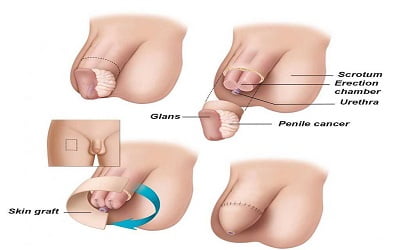 anvil tan recommends Finger In Urethra