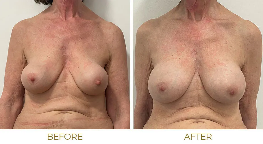 becky lake recommends 70 year old tits pic
