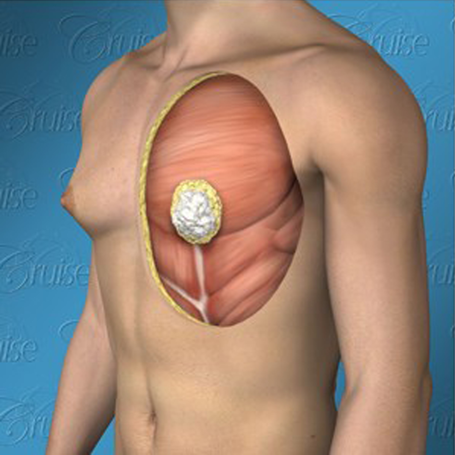 charles mhando recommends Puffy Breast Video