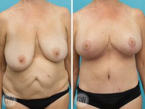 amy horvat recommends Small Saggy Mature Tits